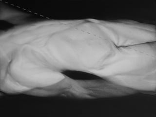 Foreign body IX